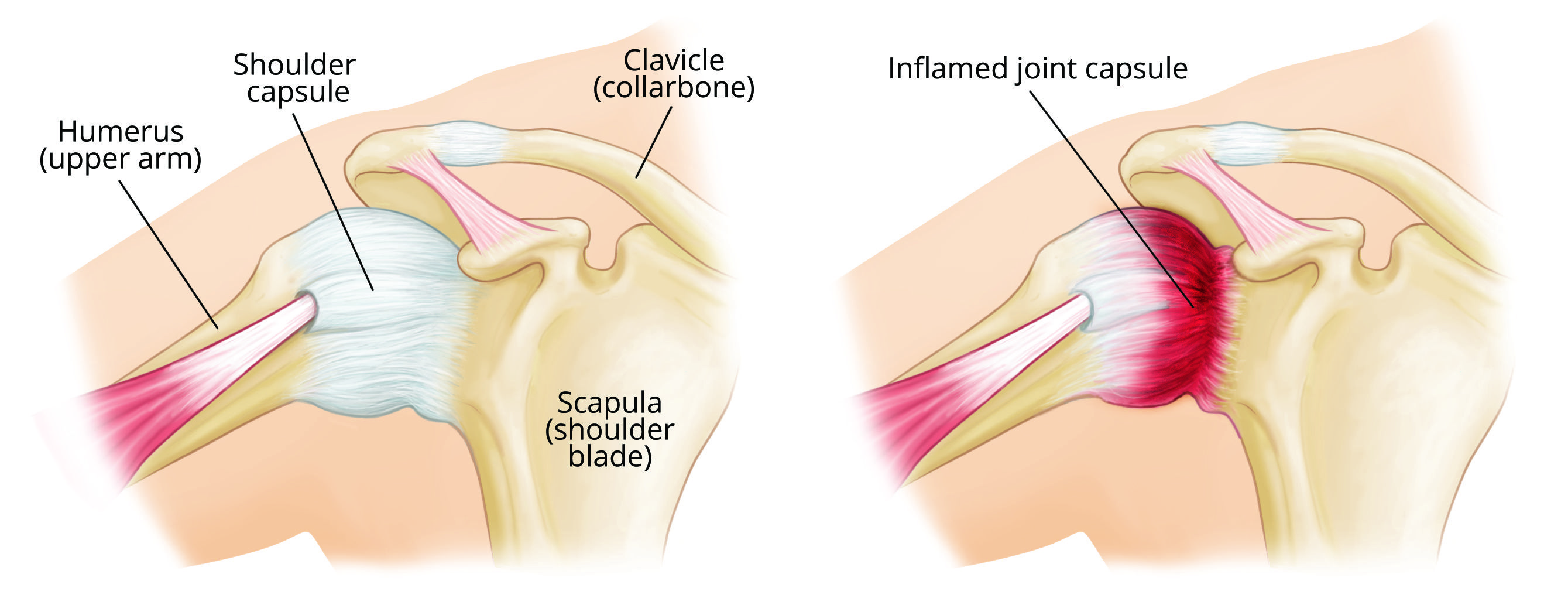 Frozen Shoulder, Hydrodilatation.....a sticky problem ...