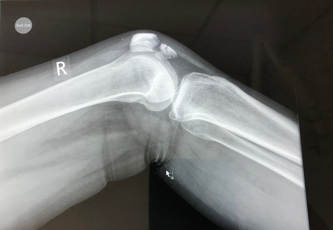 Fractured PatellaAnna's story The Iveson Clinic for Physiotherapy