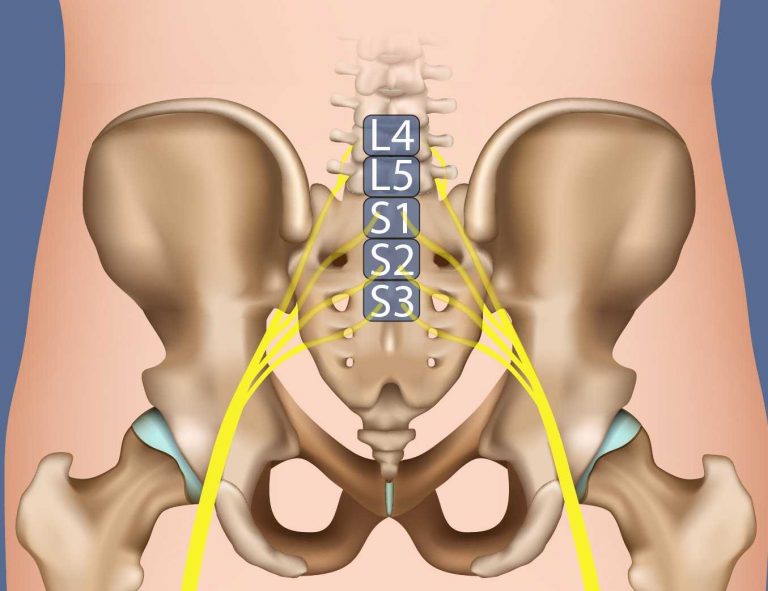 Sciatica The Iveson Clinic For Physiotherapy And Chiropractic